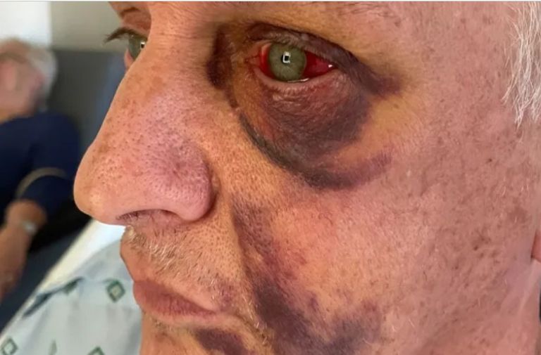 Community Rallies Around Gay Bashing Victim